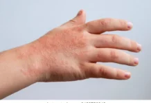 Pide la Secretaría de Salud reforzar las medidas preventivas ante casos de Coxsackie