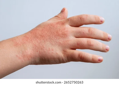red-rashes-coxsackie-virus-on-260nw-2652750263