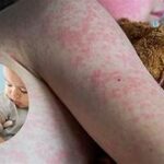 El municipio: La primera trinchera contra el sarampión