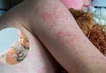 El municipio: La primera trinchera contra el sarampión